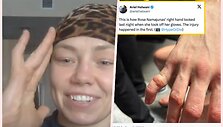 Rugsėjo pradžioje sužalotas Rose Namajunas pir&scaron;tas gyja ilgai.
