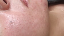 Biorevitalizacija ir rūg&scaron;tinis odos valymas &ndash; procedūros, leidžiančios džiaugtis atjaunėjusiu savo atvaizdu