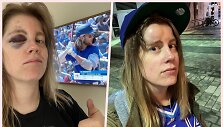 Liz McGuire pasidalino nuotraukomis, kaip ji atrodė i&scaron;kart ir praėjus &scaron;iek tiek laiko po to, kai per beisbolo rungtynes patyrė kamuoliuko smūgį į veidą.