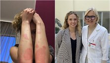 Evai i&scaron;gydyti nuo žvynelinės padėjo Klaipėdos universiteto ligoninėje parinkti biologiniai vaistai