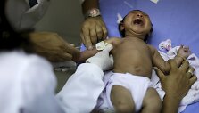 Brazilijoje dėl Zika viruso mikrocefalija sergantis kūdikis