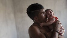 Zika virusu užsikrėtęs kūdikis Brazilijoje