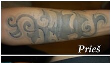 Tatuiruočių &scaron;alinimas lazeriu