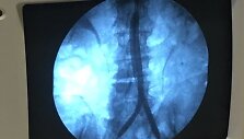 Aortos aneurizmos operacija