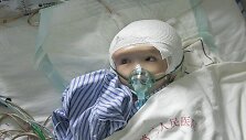 Pirmą kartą pasaulyje trimetei mergaitei i&scaron; Kinijos persodintas 3D spausdintuvu sukurtas vir&scaron;ugalvis