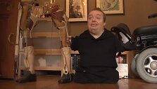 Kevinas Donnellonas, vienas konferencijos dalyvių, nukentėjęs nuo talidomido.