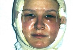 42-ejų Cindy Jackson po operacijos