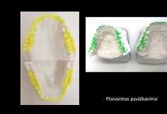 Funkcinės odontologijos pavyzdys