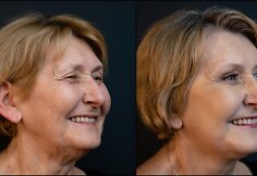 Laima Vaičiulienė prie&scaron; ir po operacijos