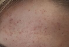 Biorevitalizacija ir rūg&scaron;tinis odos valymas &ndash; procedūros, leidžiančios džiaugtis atjaunėjusiu savo atvaizdu