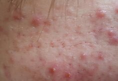 Biorevitalizacija ir rūg&scaron;tinis odos valymas &ndash; procedūros, leidžiančios džiaugtis atjaunėjusiu savo atvaizdu