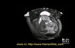 Специалистам удалось снять видео, как близнецы дерутся в утробе матери