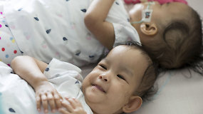 22 mėn. Siamo dvynės, išgyvenusios pavojingiausią gyvenimo operaciją, sveikos grįžo namo