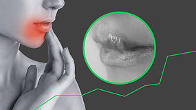 Varginanti lūpų pūslelinė: svarbiausia, ką turite žinoti