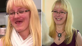 Moteris po pirmos pasaulyje viršutinio žandikaulio ir lūpos rekonstrukcijos 3D implantu vėl gali šypsotis