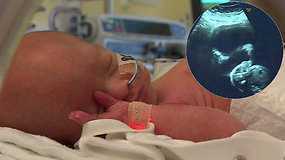 Tikras stebuklas: dar negimusiam kūdikiui įsčiose buvo atlikta stuburo operacija