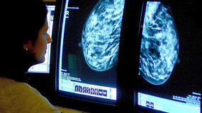Nauja era krūties vėžio gydyme – kai kuriais atvejais chemoterapija bus nereikalinga