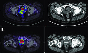 Pažangi vaizdinimo technologija PSMA PET/CT