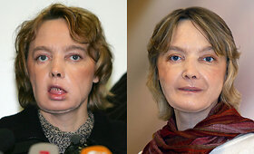 Moteris su pirmuoju pasaulyje veido transplantu