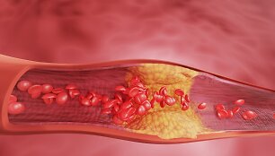 Cholesterolis
