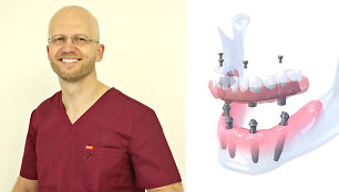 Vakarieti&scaron;ka implantacija Lietuvoje. Kokias metodikas atvežė gydytojas?