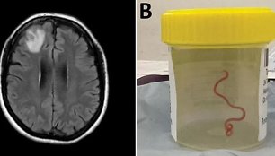 Pacientės smegenyse rastas kirminas