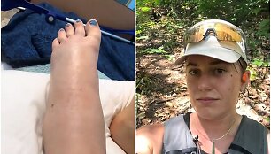 Turistės i&scaron;gelbėjimas po nuodingos gyvatės įkandimo