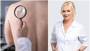 Dermatovenerologė Inga Valavičienė – apie įvairiaspalvę dedervinę