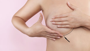 Krūtų implantai