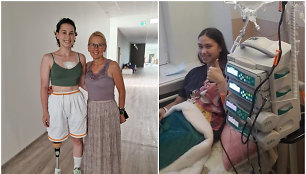 Veronikai dėl onkologinės ligos amputuota koja: dabar svajoja apie naują protezą