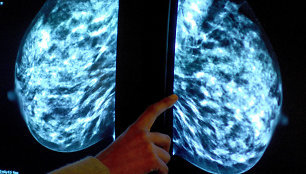 Mamogramos analizavimas