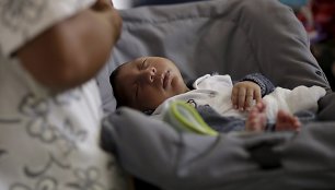 Brazilijoje dėl Zika viruso mikrocefalija sergantis kūdikis