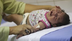 Brazilijoje dėl Zika viruso mikrocefalija sergantis kūdikis