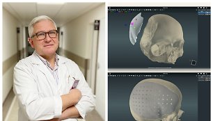 Gydytojas neurochirurgas Artūras Tamulis ir Kranialinių implantų modeliavimas 3D kompiuteriu