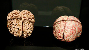 Sveikos ir Alzheimerio ligos paveiktos smegenys