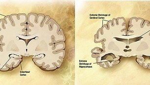 Smegenys ir Alzheimerio liga