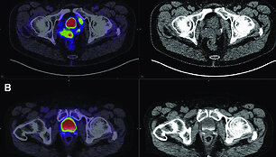 Medikai vykdo pacientų, sergančių prostatos vėžiu, tyrimus taikydami pažangią vaizdinimo technologiją, vadinamą PSMA PET/CT