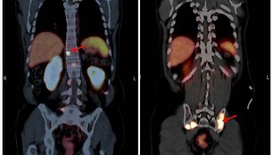 Medikai vykdo pacientų, sergančių prostatos vėžiu, tyrimus taikydami pažangią vaizdinimo technologiją, vadinamą PSMA PET/CT
