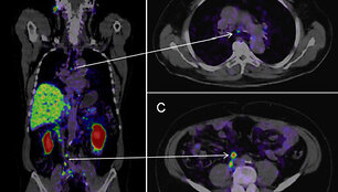 Medikai vykdo pacientų, sergančių prostatos vėžiu, tyrimus taikydami pažangią vaizdinimo technologiją, vadinamą PSMA PET/CT