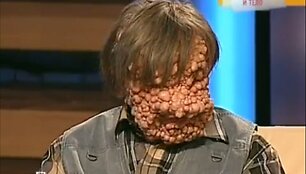Neurofibromatozės sudarkytas vyras