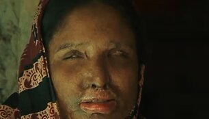 Banglade&scaron;e gyvenančiai Nurbanu vyras veidą apipylė rūg&scaron;timi