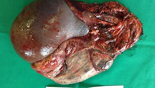 Solidinių pseudopapilinių kasos navikų pavyzdžiai po įvykusių operacijų