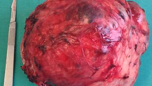 Solidinių pseudopapilinių kasos navikų pavyzdžiai po įvykusių operacijų