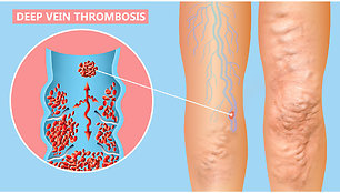 Kojų venų varikozė