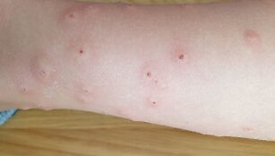 Įspėja poilsiautojus: po maudynių viename Lietuvos ežere gali atsirasti skausmingas bėrimas ir niežulys