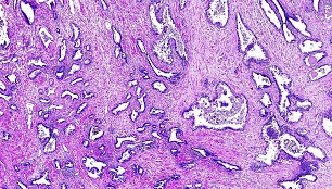 Žmogaus prostatos vėžio histologinis vaizdas