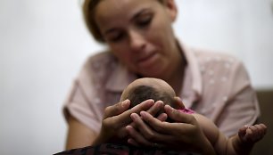 Brazilijoje dėl Zika viruso mikrocefalija sergantis kūdikis