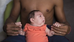 Zika virusu užsikrėtęs kūdikis Brazilijoje