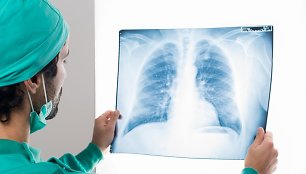 Plaučių transplantacija 