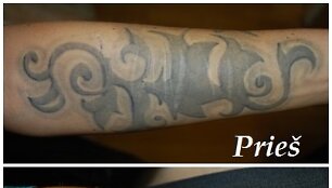 Tatuiruočių &scaron;alinimas lazeriu